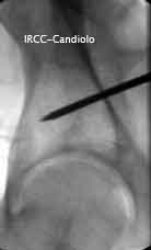 acetabolo5